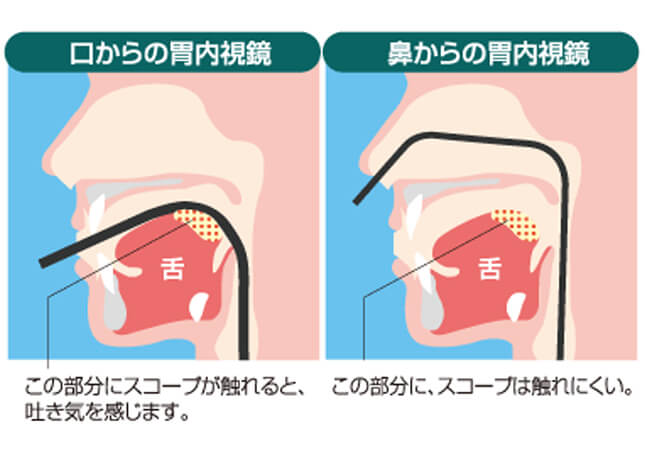 経鼻内視鏡（鼻から胃カメラを行います）